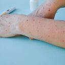 Viruela - Foto de referencia