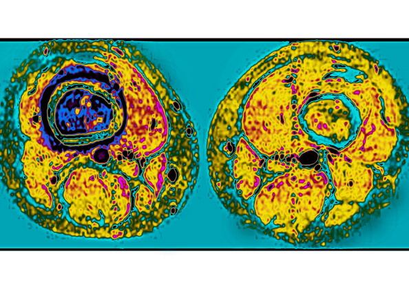Uno de los riesgos para que se presente dolor de rodilla es el cáncer: Aquellos que pueden diseminarse a los huesos o comenzar en estos.  (Photo By BSIP/Universal Images Group via Getty Images)