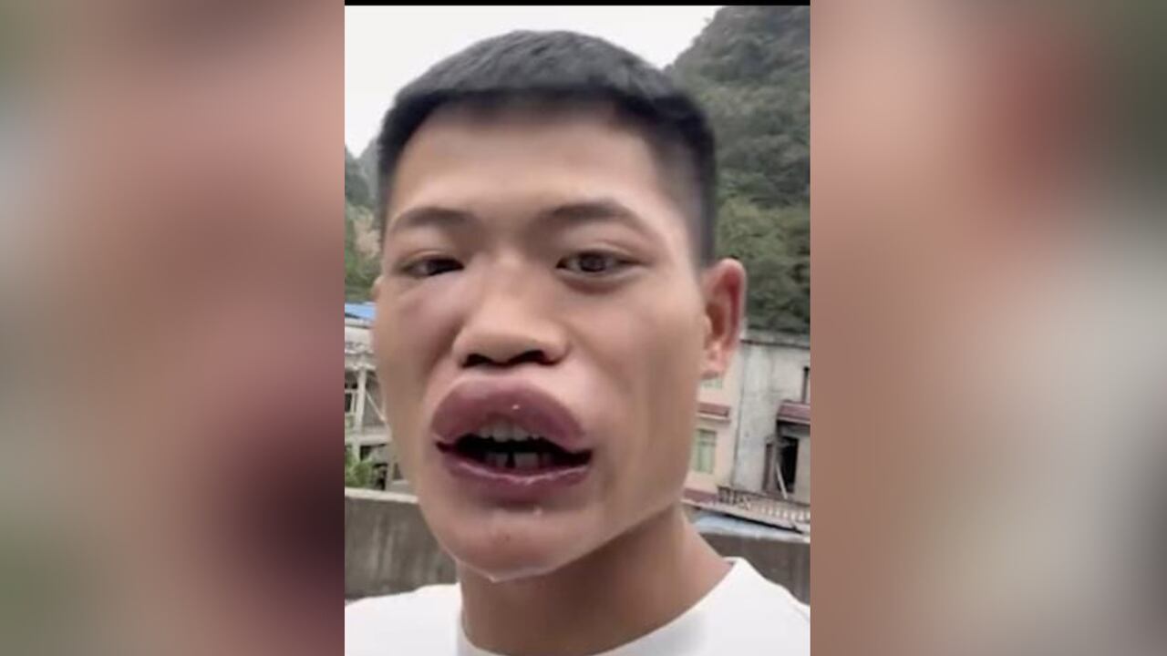 Desfigurado quedó un joven tras comerse dos abejas para un video. Imagen de video compartido por @nwakaibeya_michael en TikTok