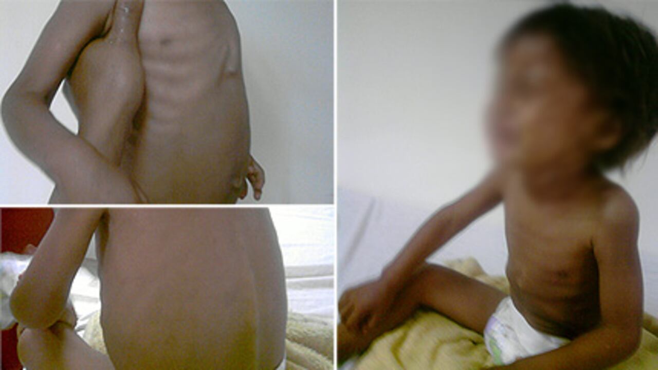 Estos son algunos de los niños que han llegado recientemente al hospital de Puerto Gaitán. Las imágenes revelan los efectos devastadores del hambre. Los menores de 3 a 5 años deben pesar entre 18 a 22 kilos; los niños raquíticos de este municipio llegan al centro médico pesando de 5 a 8 kilos.