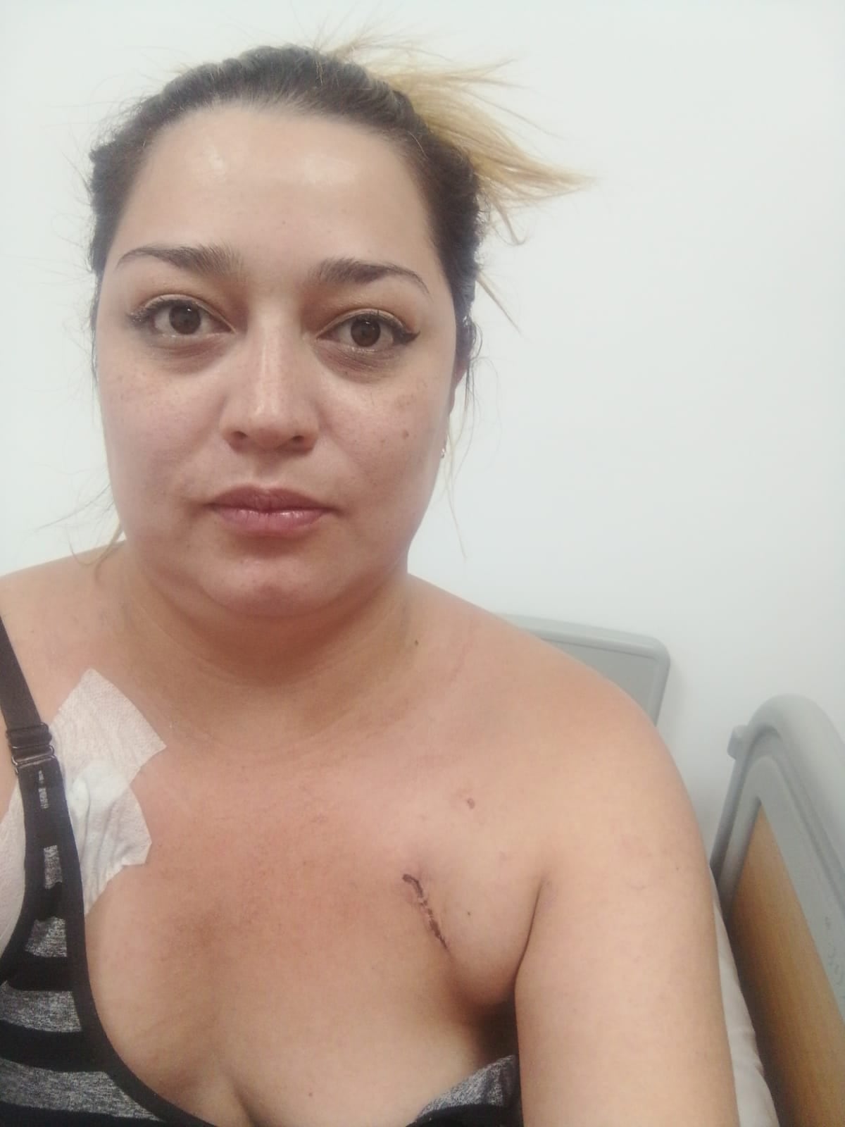 Su brazo derecho se hinchó siete veces su tamaño normal, tornándose cianótico y doloroso, limitando actividades cotidianas y laborales.