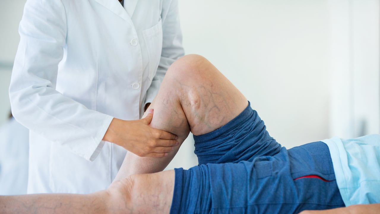 Las venas várices pueden generar complicaciones de salud, más allá de un problema estético.
