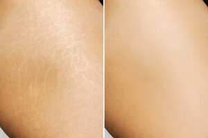 Las estrías son rayas en el cuerpo.