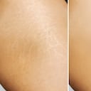 Las estrías son rayas en el cuerpo.