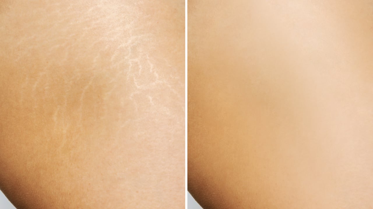 Remedios caseros para desaparecer las estrías rojas.