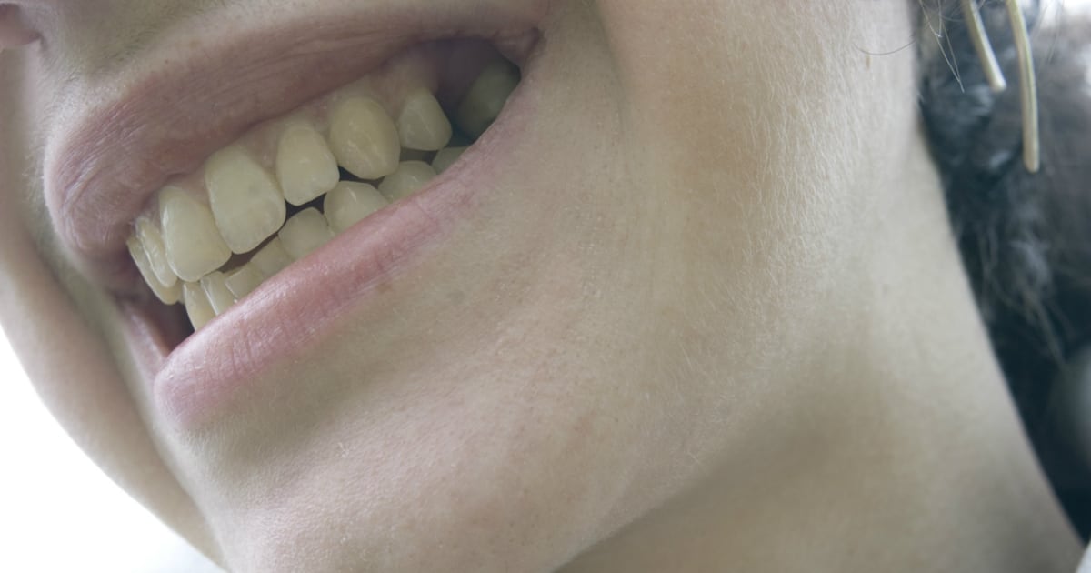 Una mala higiene bucal puede generar la gingivitis.
