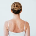 Las partes del cuerpo que se exponen al sol son las más propensas a desarrollar cáncer de piel.