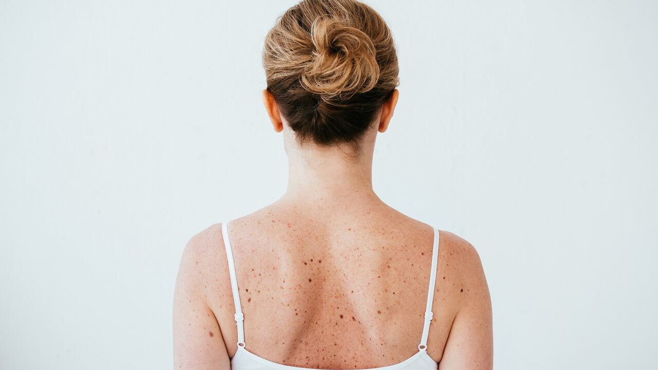 Las partes del cuerpo que se exponen al sol son las más propensas a desarrollar cáncer de piel.