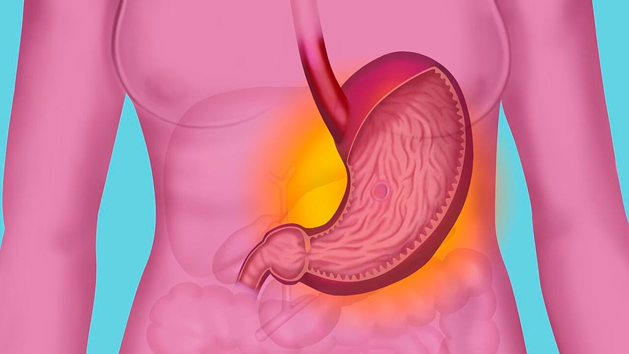 La gastritis puede aliviarse con algunas recomendaciones caseras.