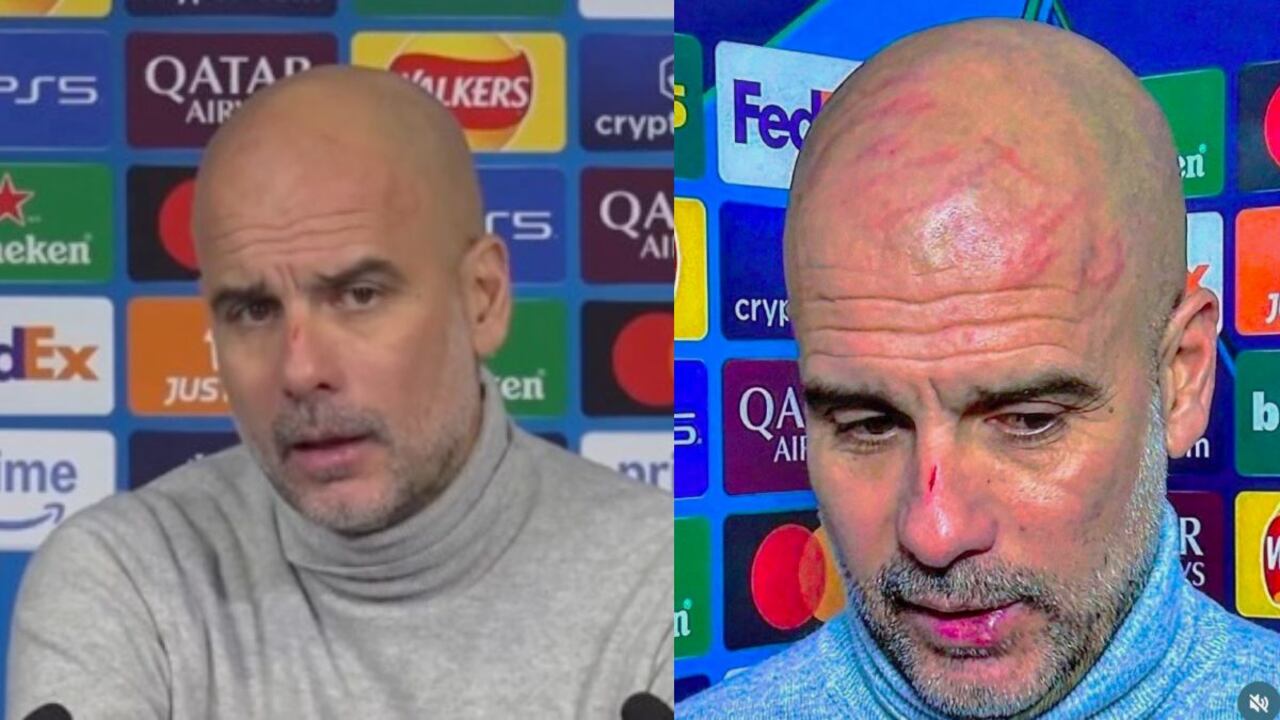 Pep Guardiola aclaró el porqué de los rasguños luego del partido entre Manchester City y Feyenoord en la Champions League.
