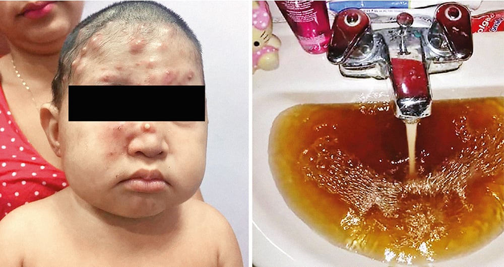  Este niño presenta una alteración genética que podría estar condicionada por metales pesados en el agua. 