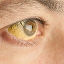 Hepatitis related jaundice