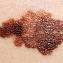Un nevo displástico puede ser síntoma de cáncer.