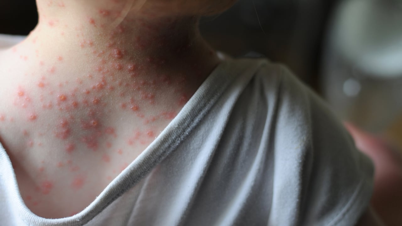 Foto de referencia sobre viruela