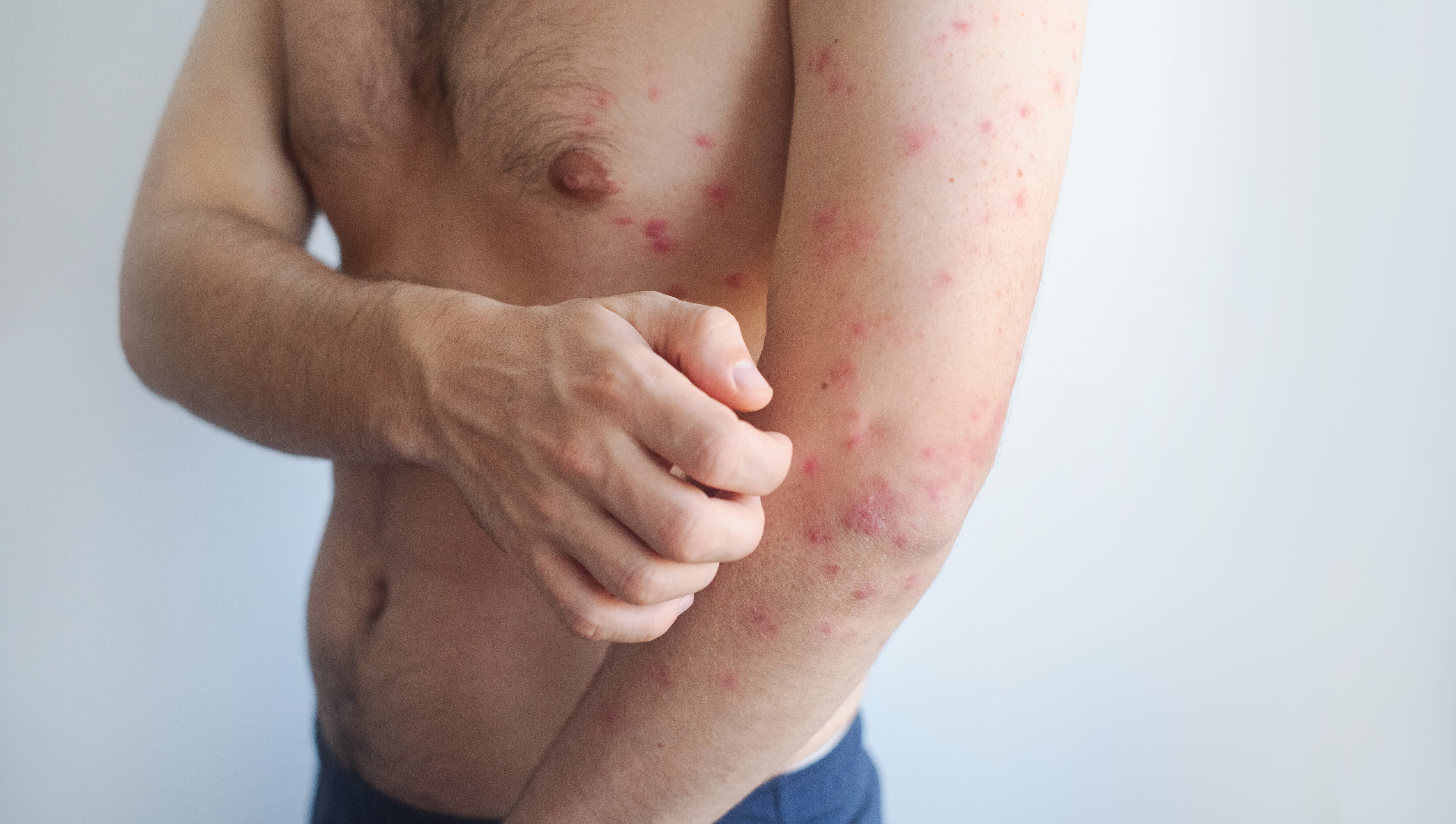 Verificar el historial de vacunación y aplicar las dosis pendientes es clave para prevenir brotes de sarampión en Colombia