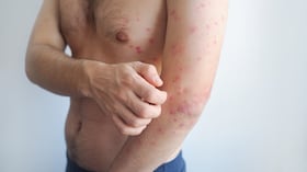 Verificar el historial de vacunación y aplicar las dosis pendientes es clave para prevenir brotes de sarampión en Colombia