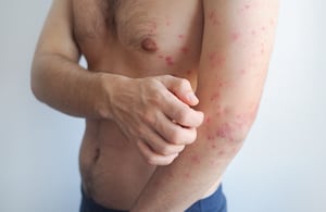 Verificar el historial de vacunación y aplicar las dosis pendientes es clave para prevenir brotes de sarampión en Colombia