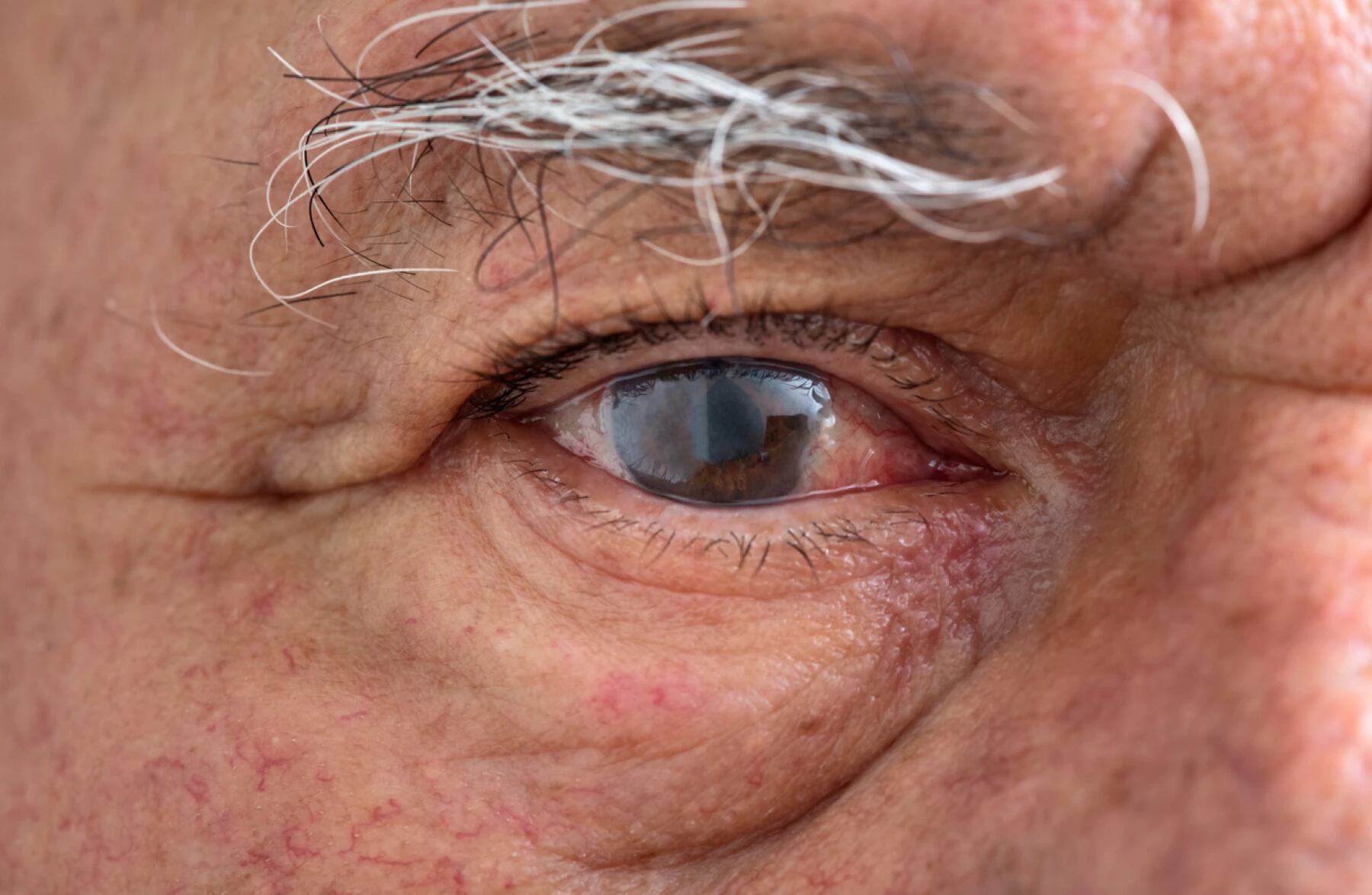 Ojo con glaucoma.  (Foto: gece33/Getty Images/iStockphoto)