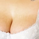 Las estrías son el surgimiento de franjas o líneas blancas sobre la piel que surgen cuando la dermis se estira rápidamente.