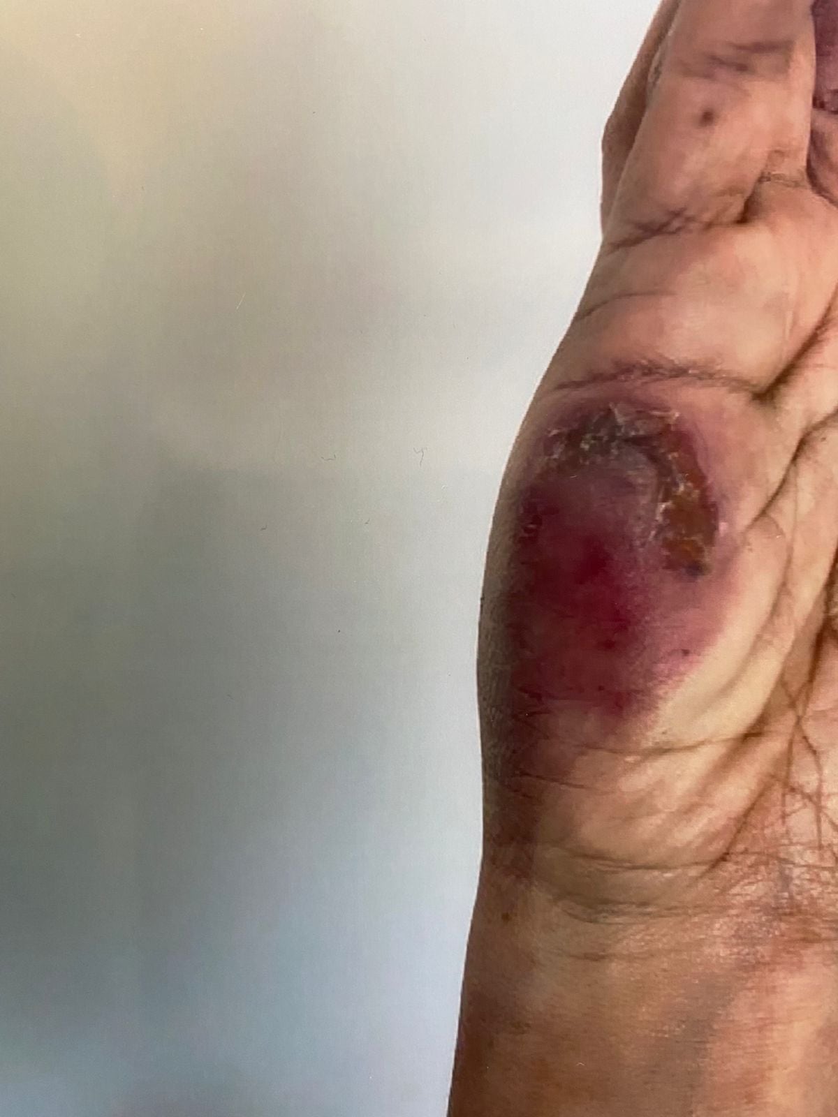 El aterrador relato de una anestesióloga atacada a mordiscos por su expareja sentimental, otro anestesiólogo