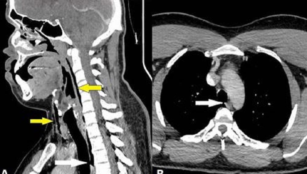 Un hombre se perforó la tráquea