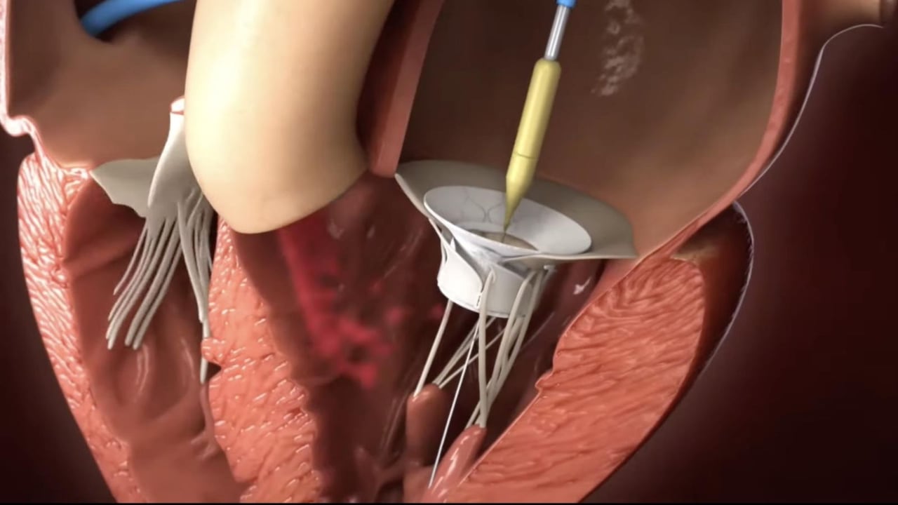 La tecnología busca reemplazar la válvula mitral mediante un catéter, evitando en determinados pacientes la apertura del tórax.