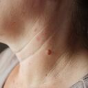 El Papiloma Cutáneo suele aparecer en la cara, cuello o espalda. Foto: Getty Images