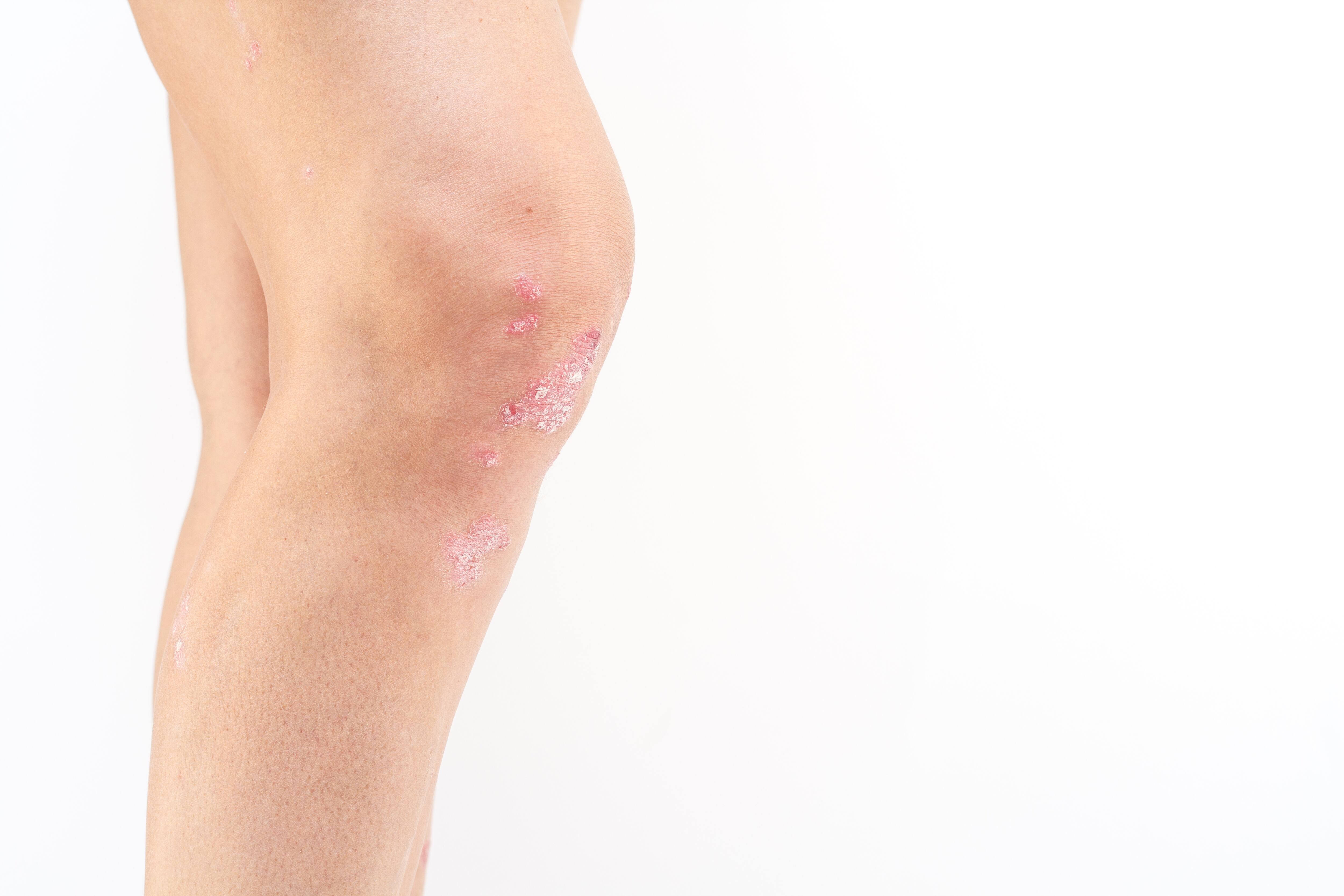 Artritis psoriásica