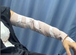 Quemaduras que sufrió Ex Miss República Dominicana en accidente que tuvo en la cocina.