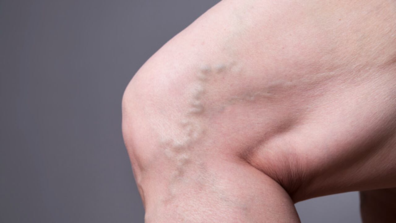 Las várices son venas agrandadas.