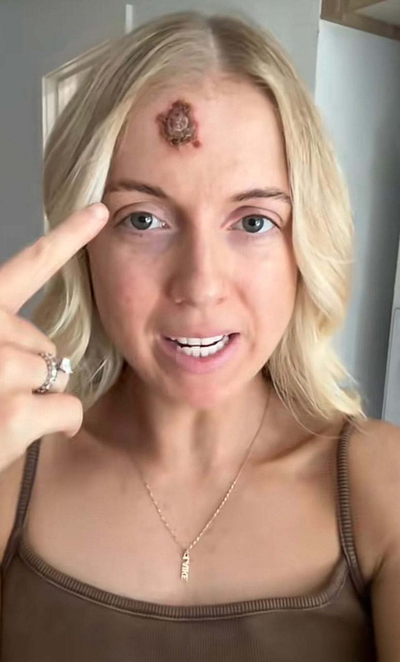 La joven utiliza un tratamiento tópico