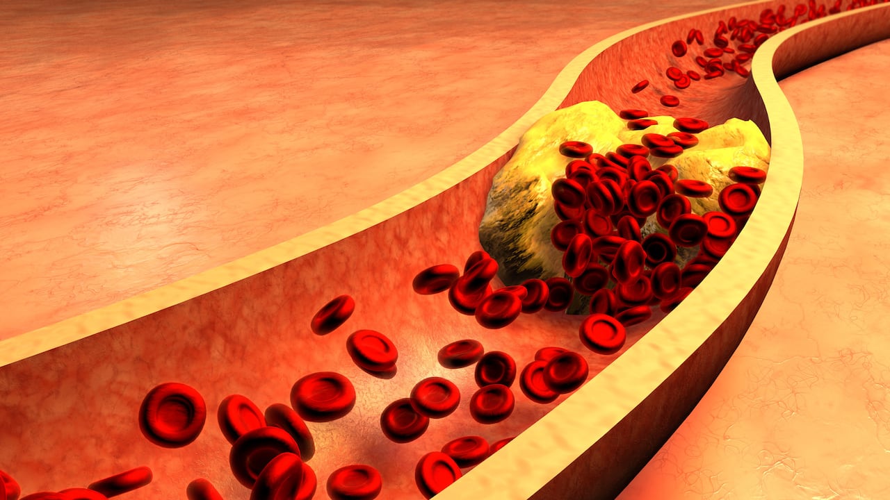 Un colesterol alto puede traer consigo varias enfermedades que pueden ser mortales.