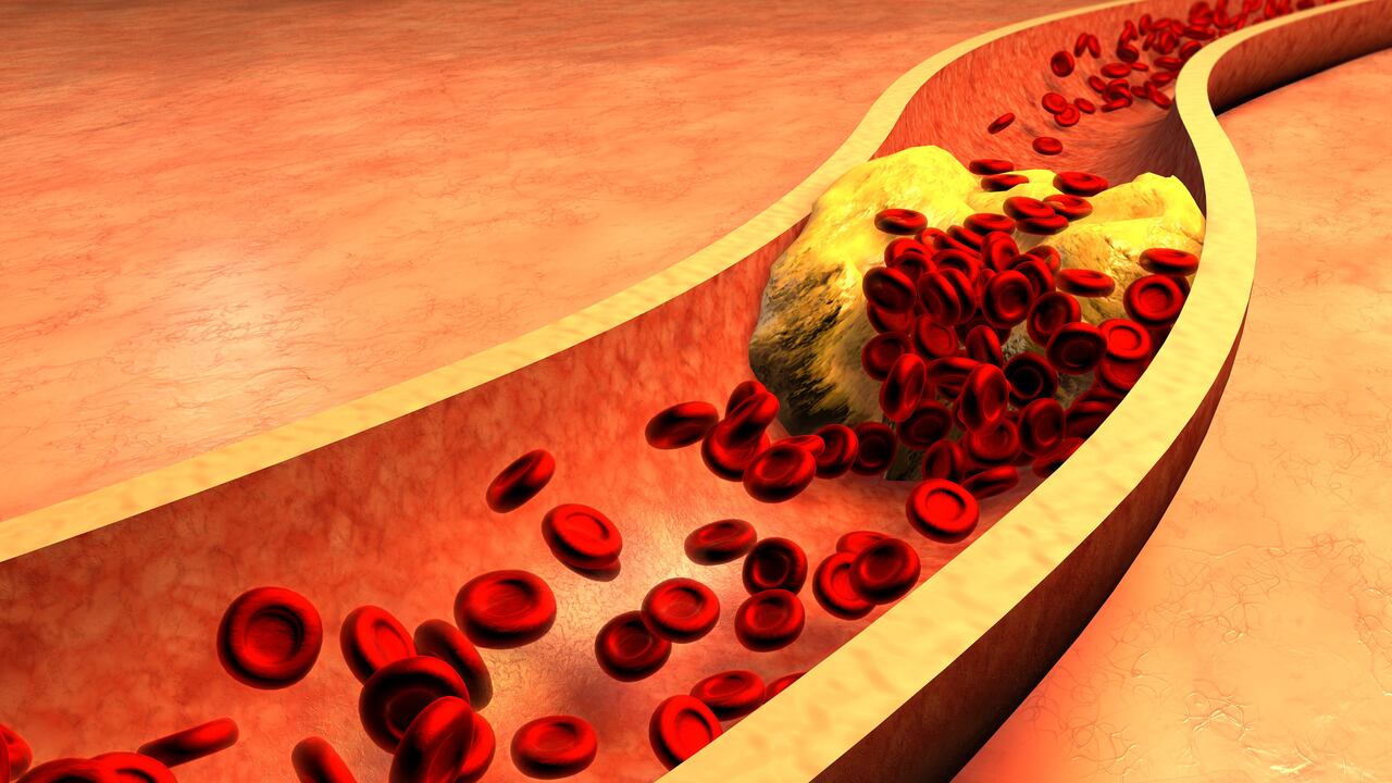 Un colesterol alto puede traer consigo varias enfermedades que pueden ser mortales.