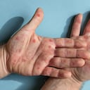 Manos de un paciente contagiado con la viruela del mono