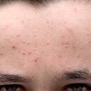 El acné es un trastorno cutáneo.