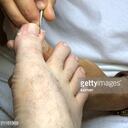 Si se desea se puede consultar con un podólogo.