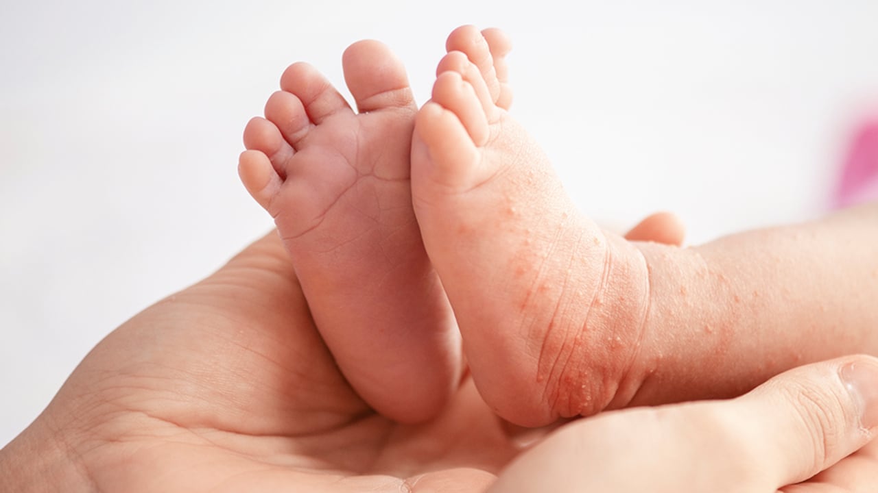 Expertos conversan sobre la enfermedad de manos, pies y boca.