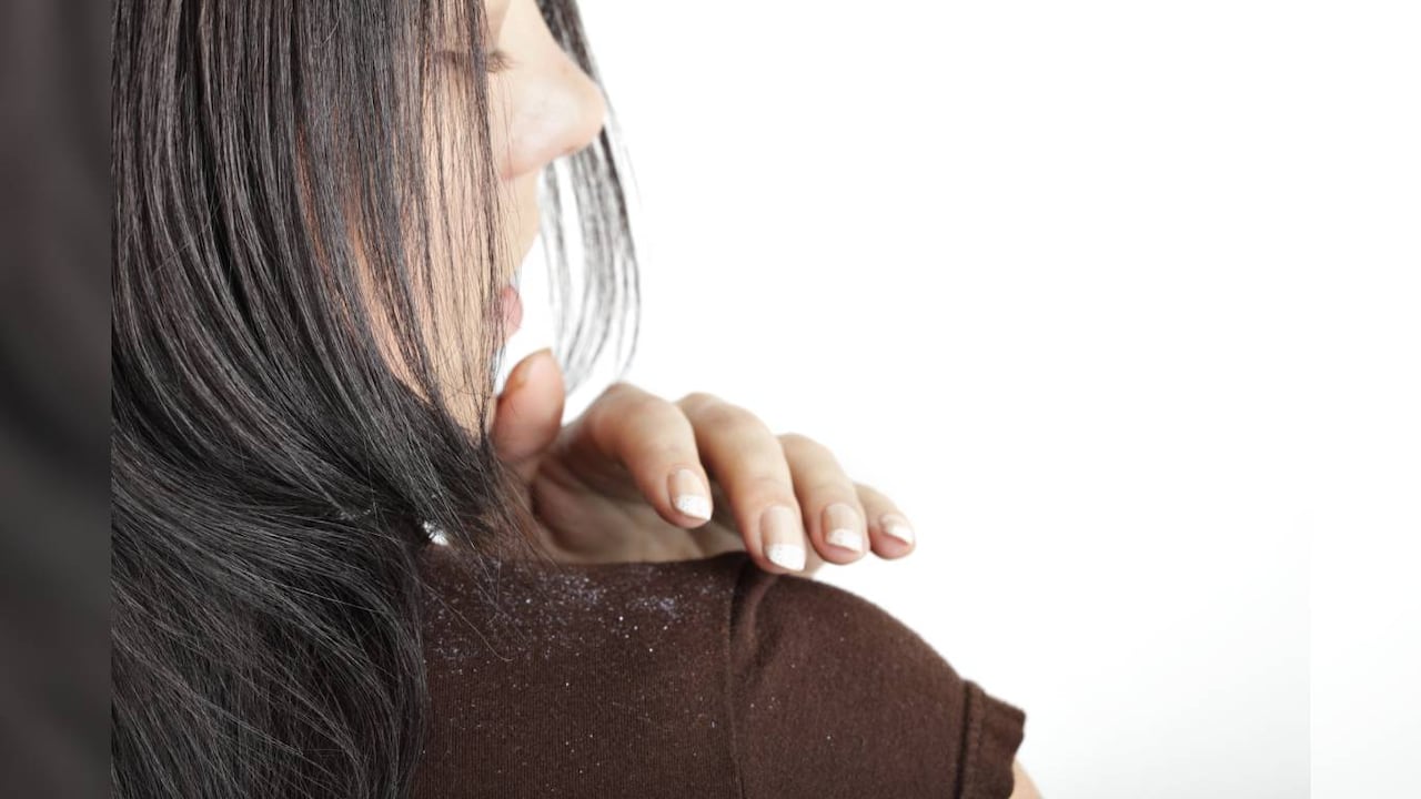 La alimentación también es importante para eliminar la caspa. Foto: Getty images.