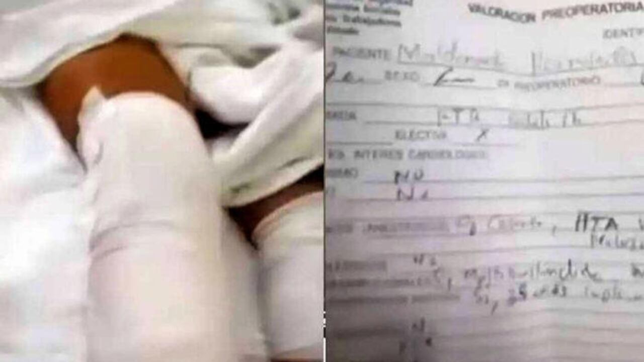Un caso de negligencia médica fue denunciado en México, luego de que a una mujer de 67 años, le fue amputada una pierna que estaba en buenas condiciones.