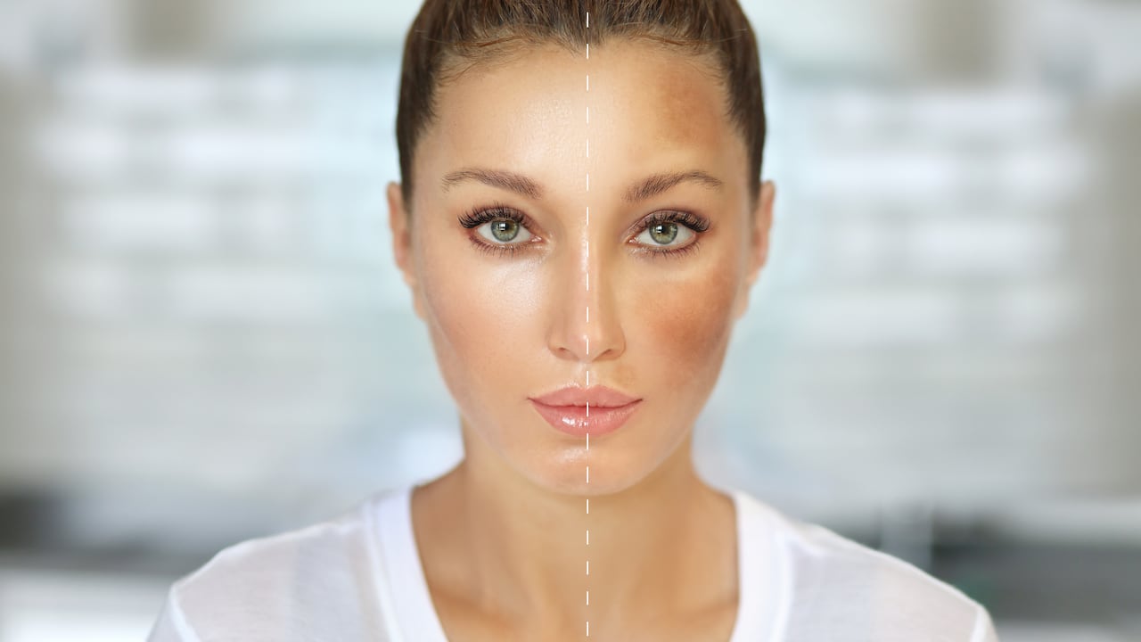 Las manchas en la piel suelen aparecer tras la exposición al sol.