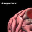 Algunos aneurismas aparecen después de una lesión en la cabeza o a partir de ciertas infecciones en la sangre.