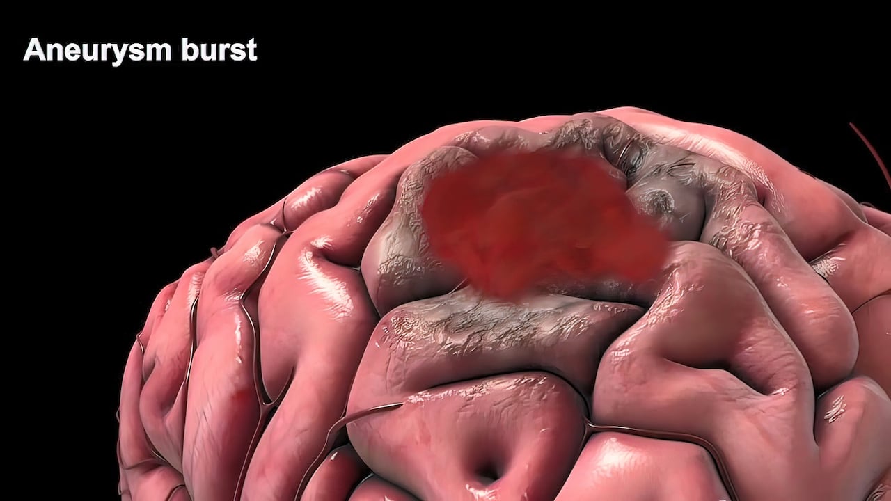 Algunos aneurismas aparecen después de una lesión en la cabeza o a partir de ciertas infecciones en la sangre.