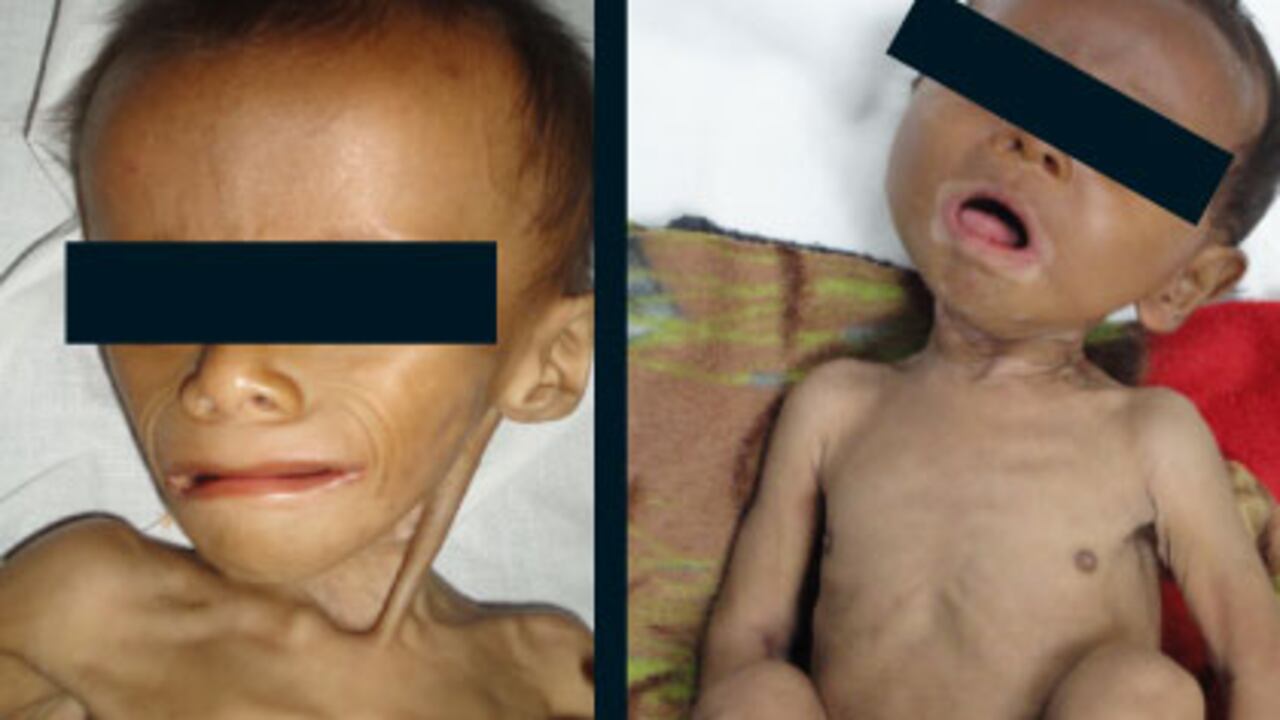 Estos son algunos de los niños que han llegado recientemente al hospital de Puerto Gaitán. Las imágenes revelan los efectos devastadores del hambre. Los menores de 3 a 5 años deben pesar entre 18 a 22 kilos; los niños raquíticos de este municipio llegan al centro médico pesando de 5 a 8 kilos.