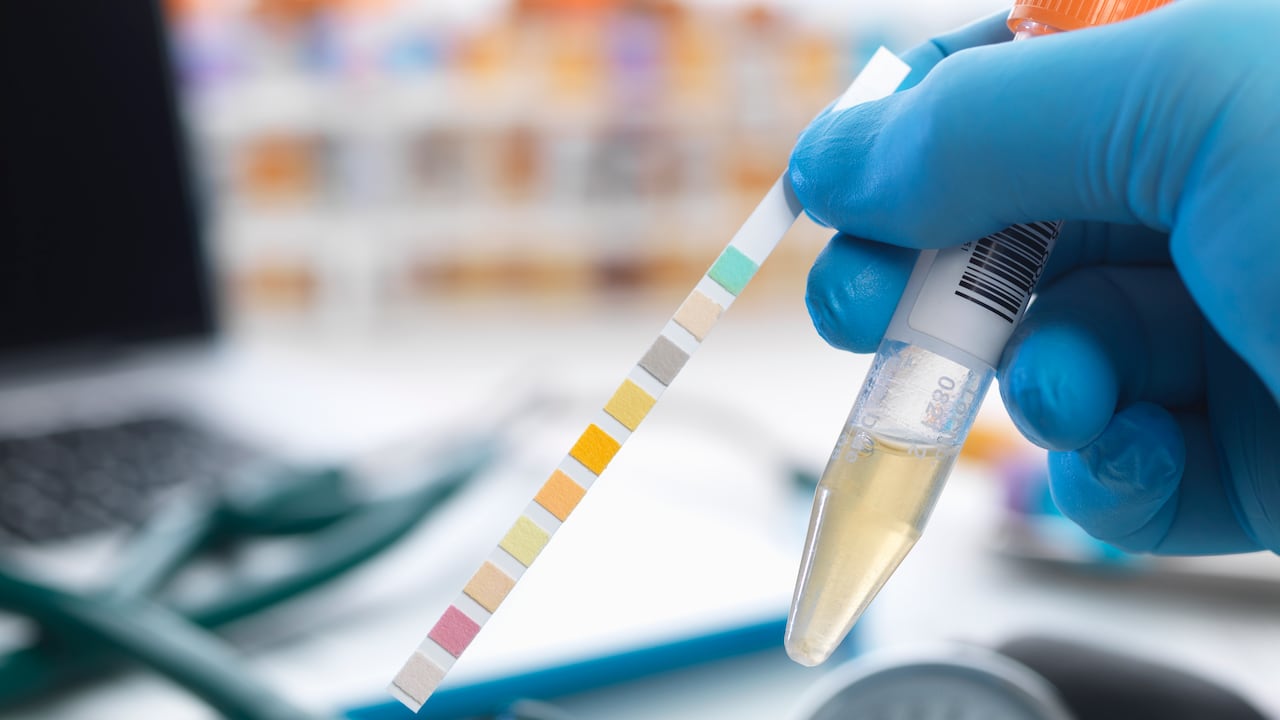 Resultado de exámenes de orina