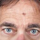 Manchas hepáticas - Adulto Mayor