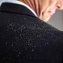 Además de los tratamientos cosméticos, los remedios naturales también ayudan a eliminar la caspa. Foto: GettyImages.