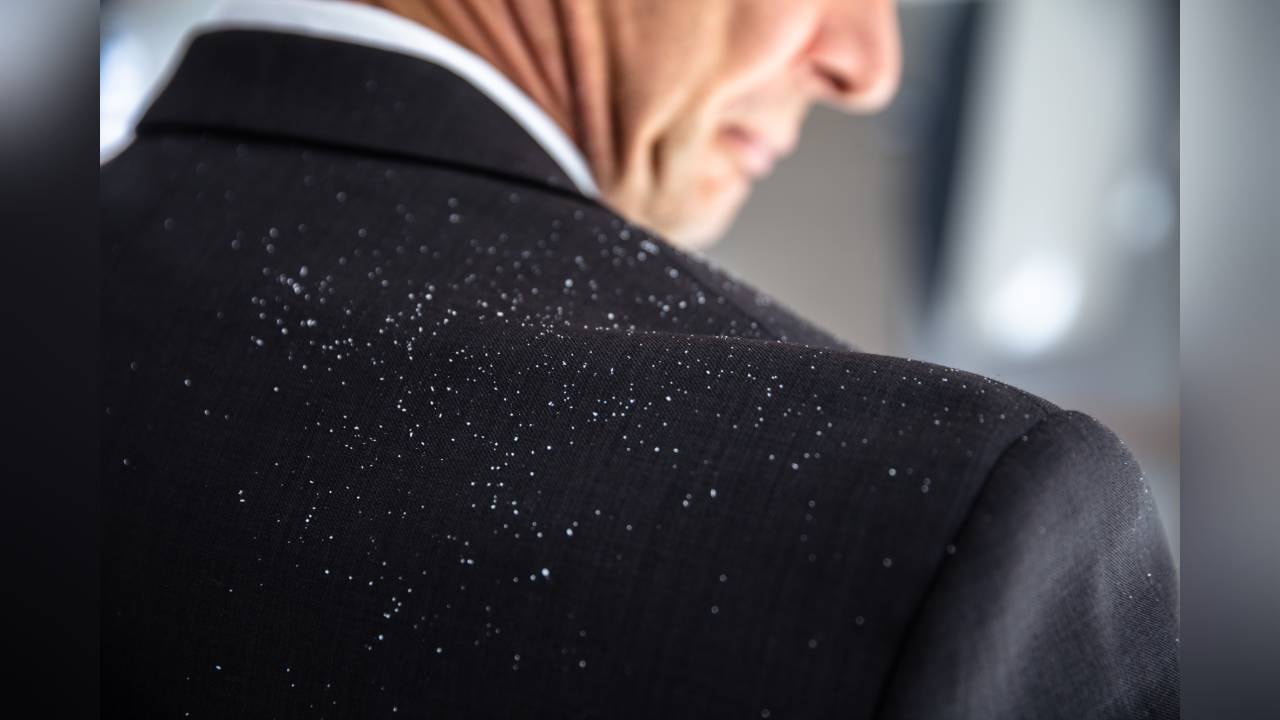 Los tratamientos cosmético y, los remedios naturales también ayudan a eliminar la caspa.