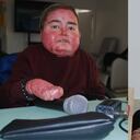 Pacientes con Piel de Mariposa.
Santiago Vargas y Valery Ramírez