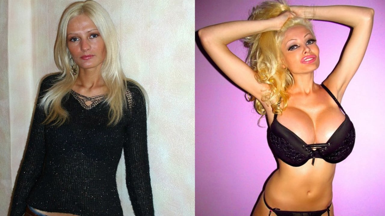 Victoria Wild, antes y después de someterse a seis cirugías plásticas.