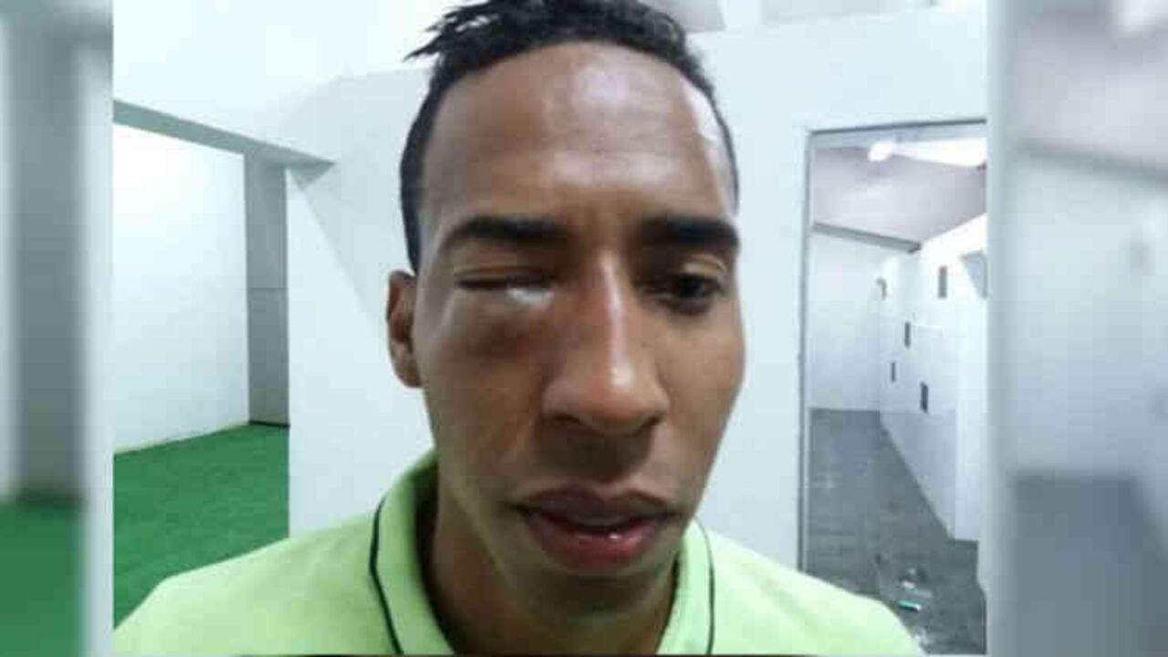Así quedó el jugador Edison Mosquera, de Nacional, tras agresión.